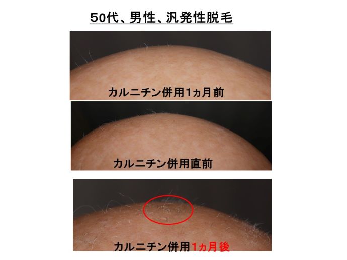 円形脱毛症　病院